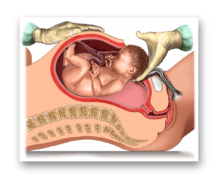 taglio-cesareo-ostetricia-ginecologo-trento